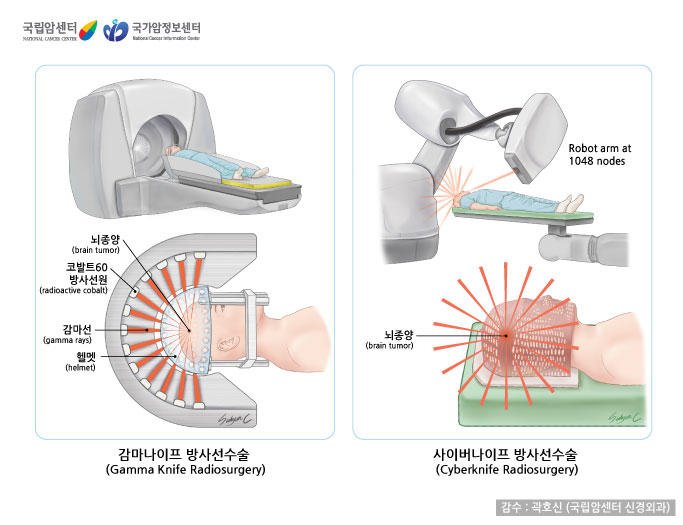 감마나이프 방사선수술(Gamma Knife Radiosurgery)와 사이버나이프 방사선수술(Cyberkinife Radiosurgery)