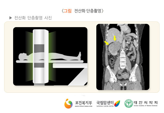 전산화 단층촬영 사진 (출처: 국립암센터, 국가암정보센터)