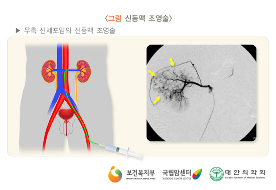 신동맥 조영술 (출처: 보건복지부, 국립암센터, 대한의학회)