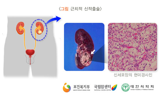 [그림: 근치적 신적출술] (출처: 보건복지부, 국립암센터, 대한의학회)