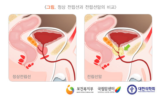 [그림: 정상 전립선과 전립선암의 비교] 정상전립선과 전립선암(출처: 보건복지부, 국립암센터, 대한의학회)