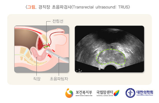 [그림:경직장 초음파검사(Transrectal ultrasound:TRUS)]직장수지검사, 혈청 전립선특이항원 (PSA)검사