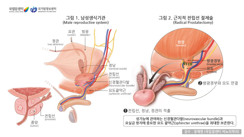 [그림: 남성의 생식기관과 근치적 전립선 절제술]