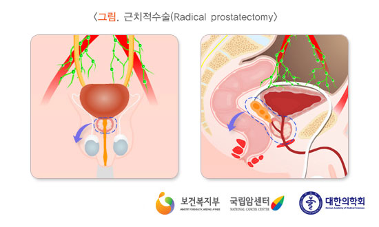 [그림: 근치적수술(Radical prostatectomy)] 출처: 보건복지부, 국립암센터, 대한의학회