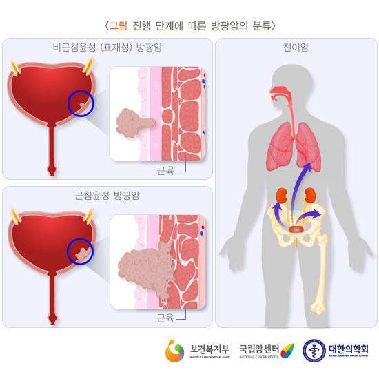 [그림: 진행단계에 따른 방광암의 분류]비근침윤성(표재성) 방광암 / 근침윤성 방광암 / 전이암 (출처: 보건복지부, 국립암센터, 대한의학회)