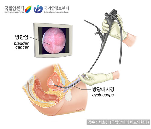 내시경으로 보는 방광암 (출처: 국립암센터, 국가암정보센터)