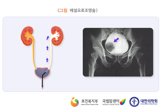 배설요로 조영술 (출처: 보건복지부, 국립암센터, 대한의학회)