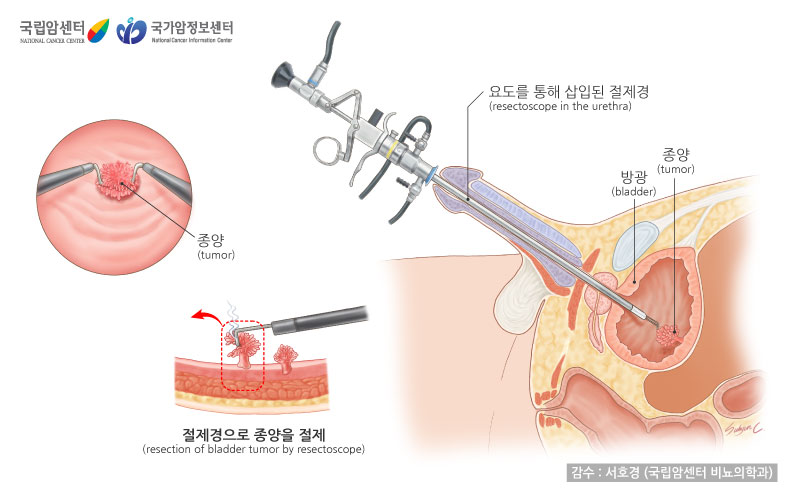 절제격으로 종양을 절제, 요도를 통해 삽입된 절제경(출처: 국립암센터, 국가암정보센터)
