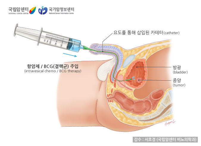 항암제/BCG(결핵균) 주입, 요도를 통해 삽입된 카테터 (출처: 국립암센터, 국가암정보센터)