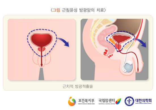 [그림: 근침윤성 방광암의 치료]근치적 방광적출술(출처: 보건복지부, 국립암센터, 대한의학회)