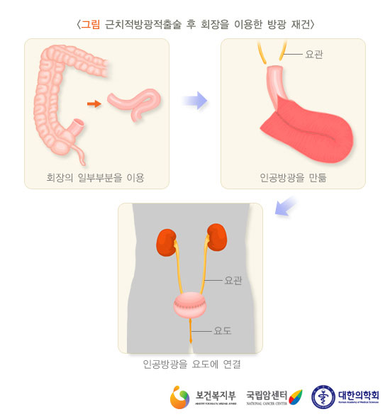 [그림: 근치적방광적출술 후 회장을 이용한 방광 재건] 회장의 일부부분을 이용→인공방광을 만듦→인공방광을 요도에 연결(출처: 보건복지부, 국립암센터, 대한의학회)