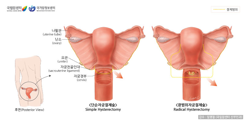 자궁 후면, 단순자궁절제술, 광범위자궁절제술(출처: 국립암센터, 국가암정보센터)