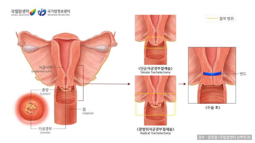 단순자궁절제술과 광범위자궁절제술의 수술범위, 수술후(출처: 국립암센터, 국가암정보센터)