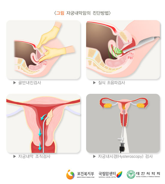 [그림: 자궁내막암의 진단방법] 골반내진검사, 질식 초음파검사, 자궁내막 조직검사, 자궁내시경 검사(출처: 보건복지부, 국립암센터, 대한의학회)