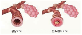 정상기도와 천식환자기도 이미지