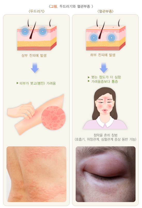 그림 두드러기와 혈관부종