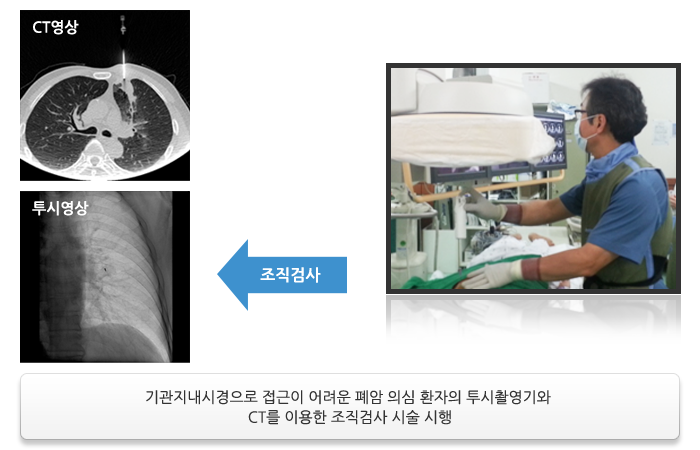 조직검사 → 투시영상, CT영상 : 기관지내시경으로 접근이 어려운 폐암 의심 환자의 투시촬영기와 CT를 이용한 조직검사 시술 시행